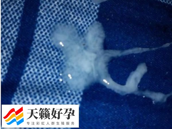 死精率高还能不能做一代试管婴儿(图1)